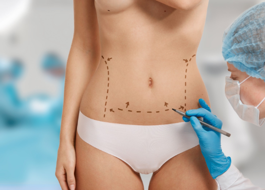 Liposuction Liposuction